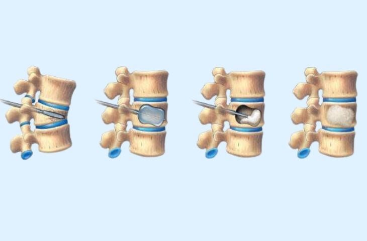 cách điều trị xẹp đốt sống lưng