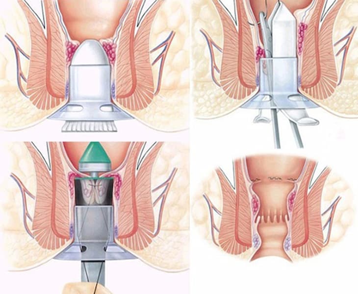 Điều trị khi bị sa búi trĩ bằng phương pháp Longo