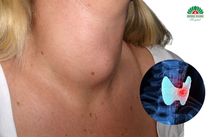 Nhân xơ tuyến giáp