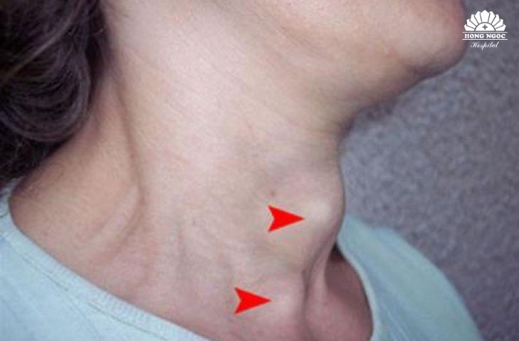 Tuyến giáp phát triển khiến vùng cổ phình to bất thường