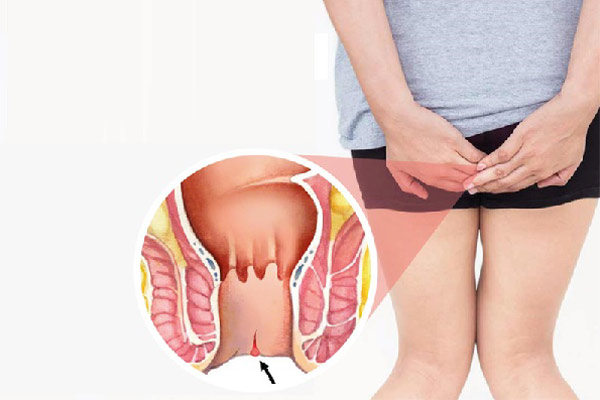 Nứt kẻ hậu môn