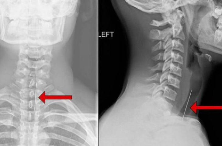 điều trị thoái hóa đốt sống cổ