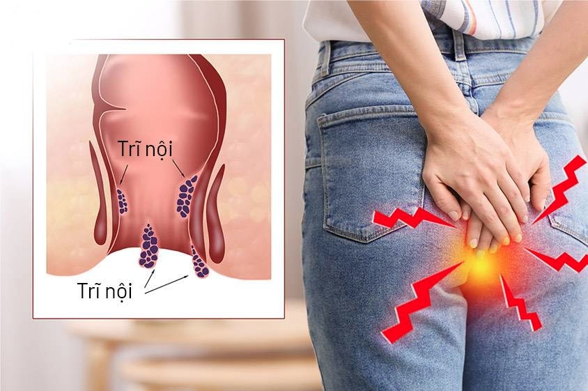 Trĩ nội gây nhiều phiền toái cho người bệnh nhưng khó nhận biết