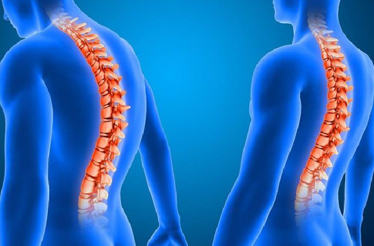 Triệu chứng loãng xương