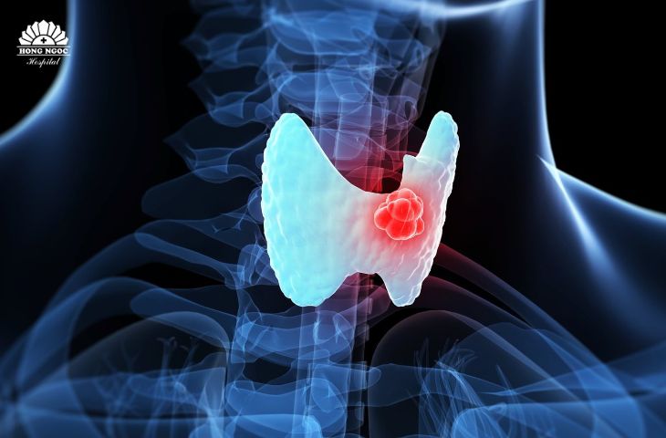 Khối u nang tuyến giáp phát triển