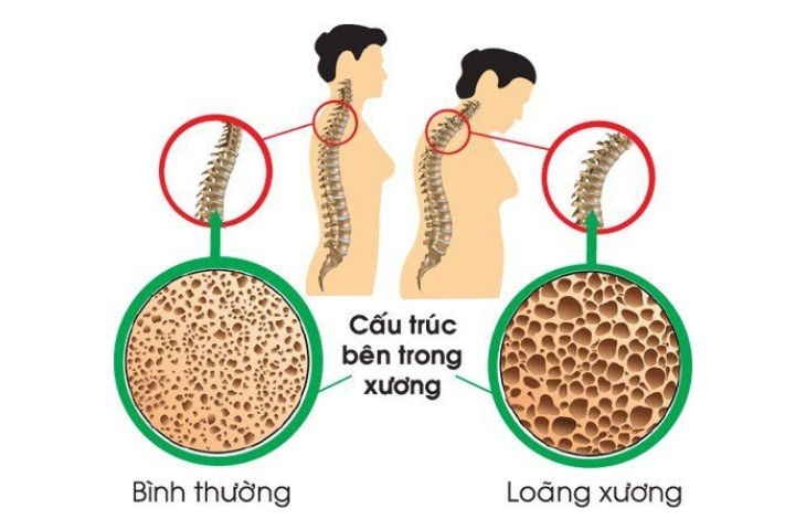 xẹp đốt sống lưng có nguy hiểm không