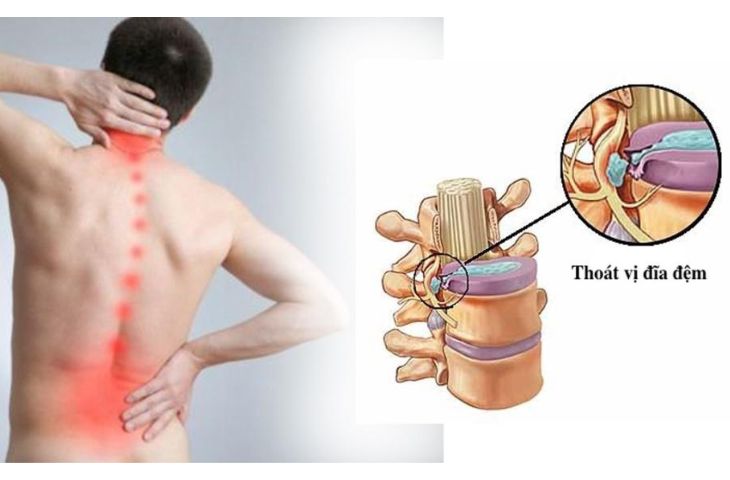 xẹp đốt sống lưng có nguy hiểm không