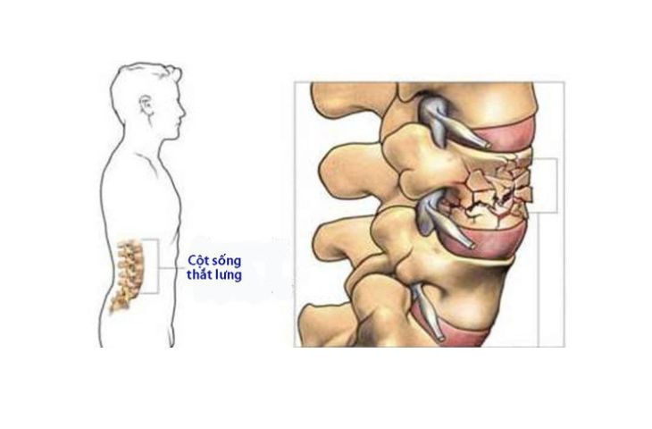 xẹp đốt sống lưng có nguy hiểm không