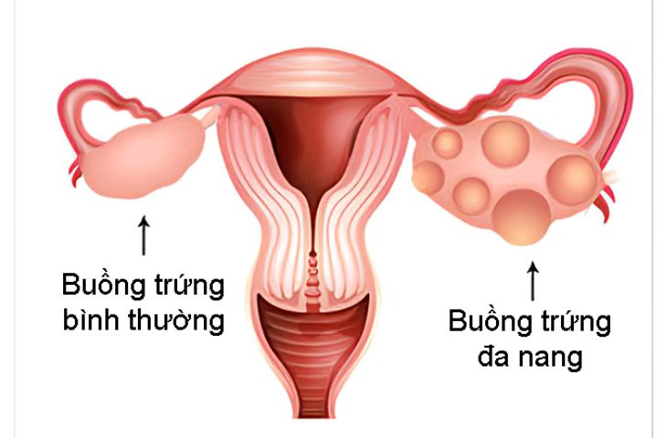 Hội chứng buồng trứng đa nang có nguy cơ di truyền