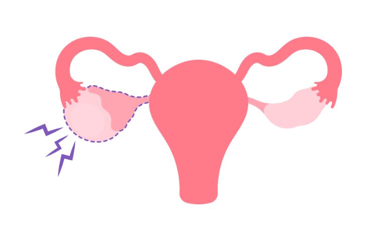 Buồng trứng đa nang là bệnh phụ khoa thường gặp ở nhiều chị em trong độ tuổi sinh đẻ