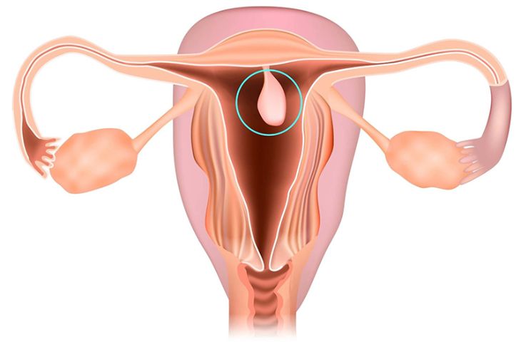 Bệnh phụ khoa thường gặp