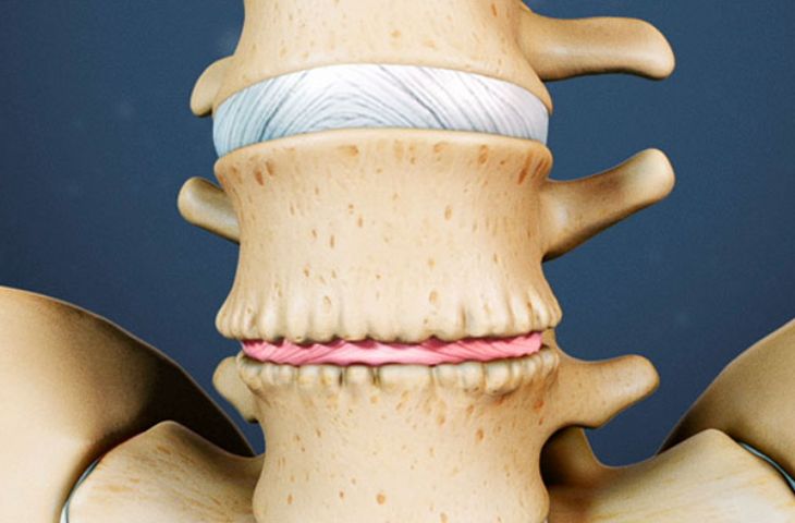 Chi phí bơm xi măng cột sống