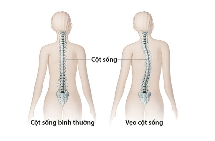 chữa vẹo cột sống
