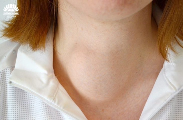 Đi tìm nguyên nhân bệnh cường giáp chuyển sang suy giáp