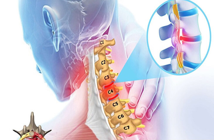 phình đĩa đệm đốt sống cổ
