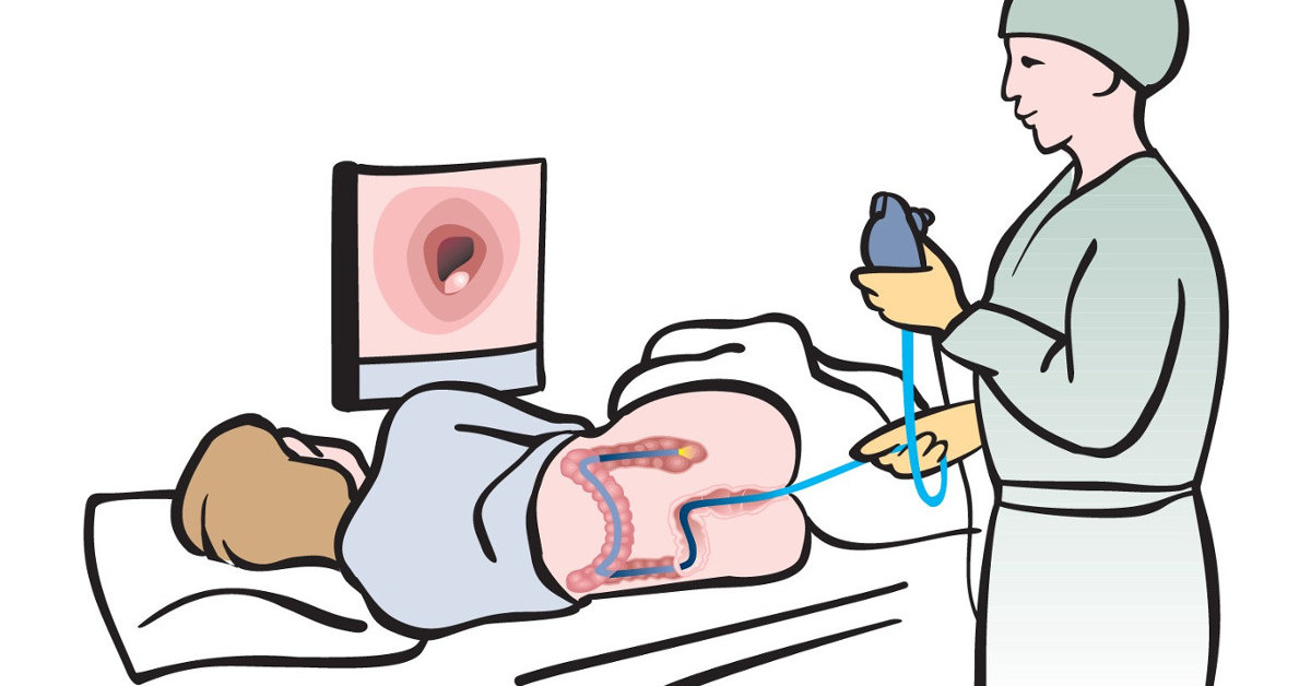 Nội soi đại tràng là một trong những phương pháp để loại bỏ polyp hậu môn