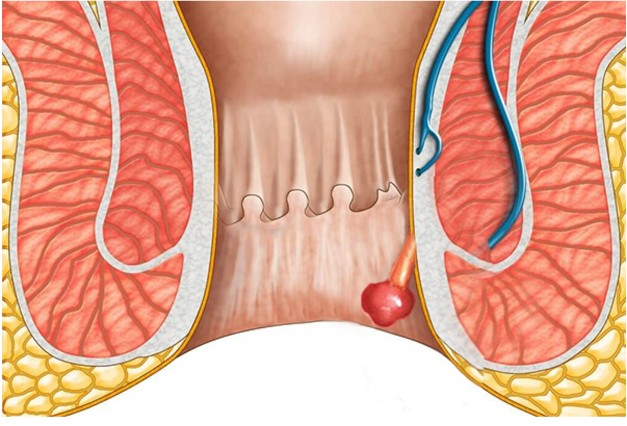 Polyp hậu môn dễ nhầm với bệnh trĩ