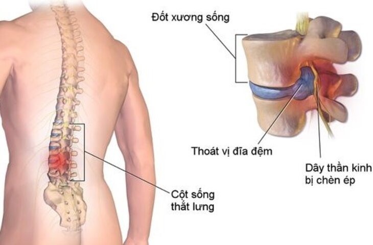 thoát vị đĩa đệm có chữa được không