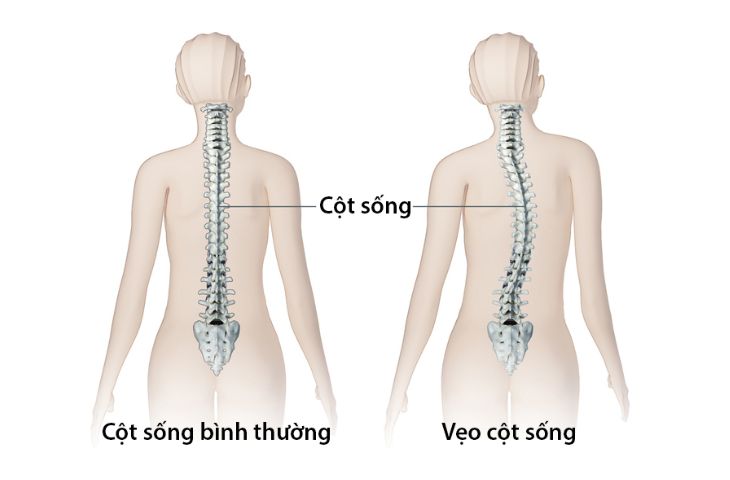 Vẹo cột sống