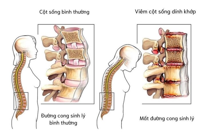 viêm cột sống dính khớp