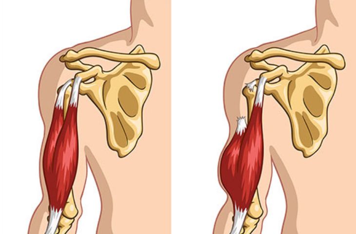 viêm điểm bám gân