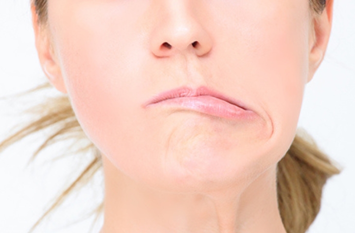 phục hồi chức năng sau liệt mặt