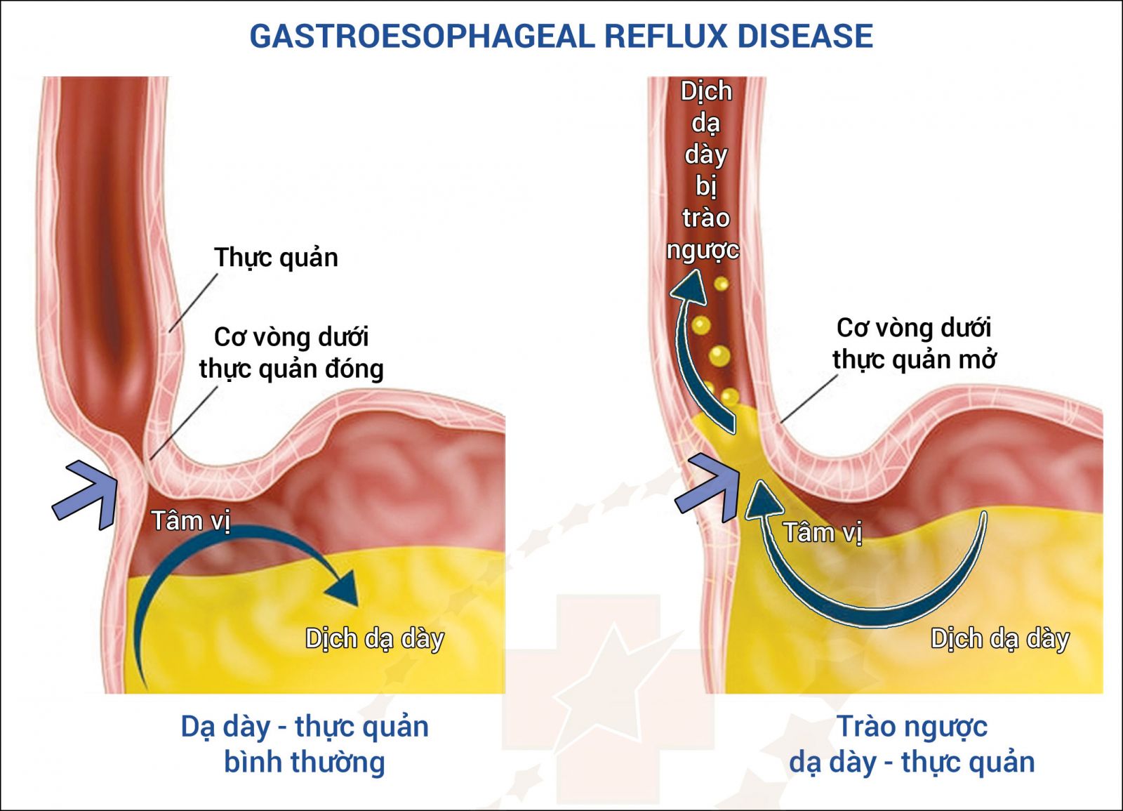 Trào ngược dạ dày 