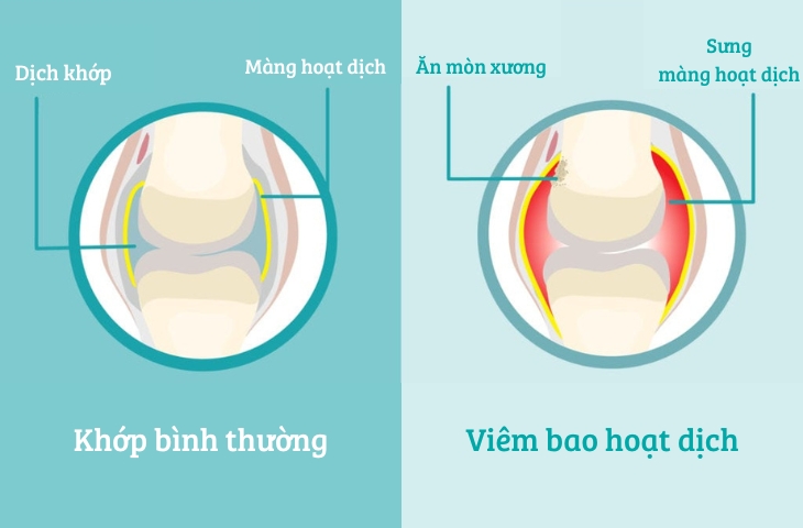 viêm bao hoạt dịch
