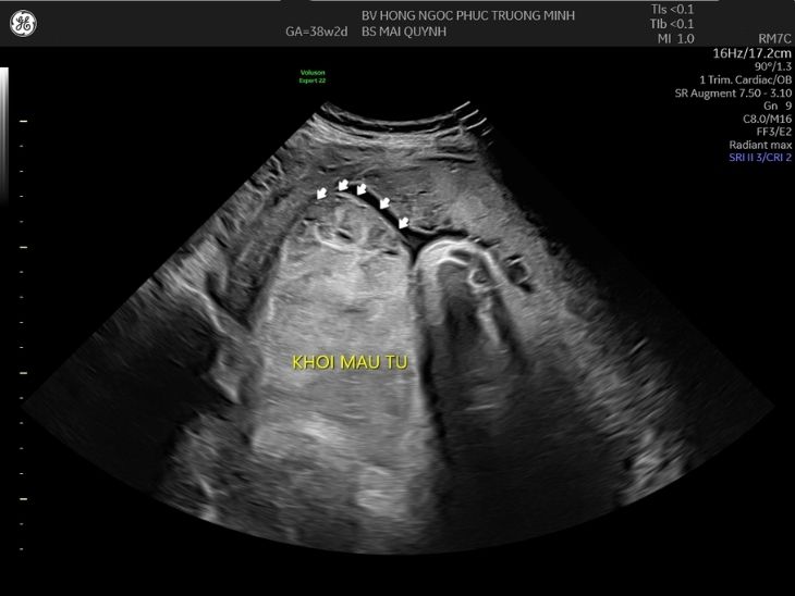 Nhau bong non thể nặng