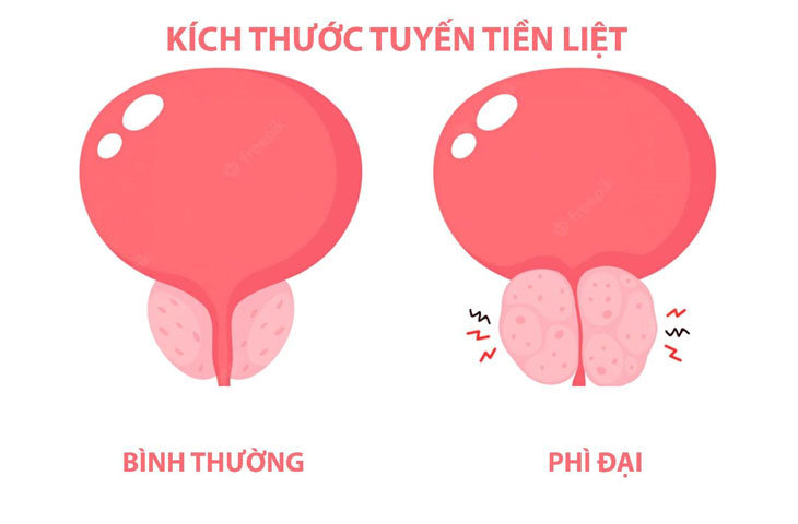 dieu tri phi dai tien liet tuyen