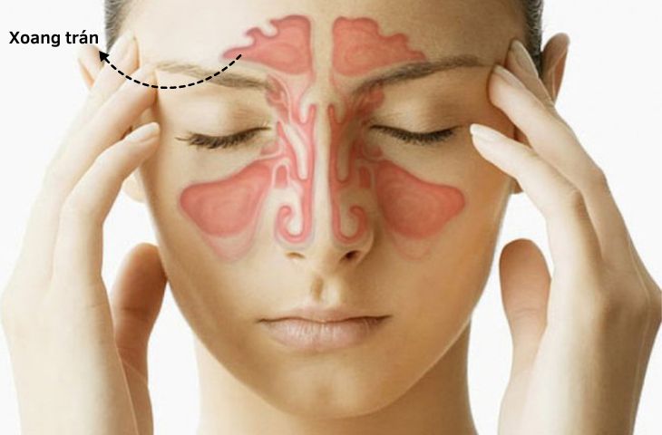hình ảnh viêm xoang trán