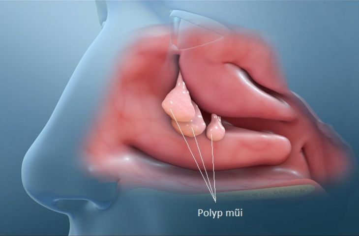 Nguyên nhân viêm xoang sàng