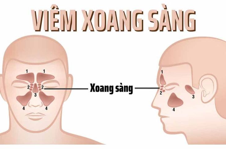 Nhận biết viêm xoang sàng