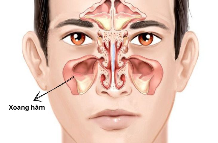 Vị trí viêm xoang hàm