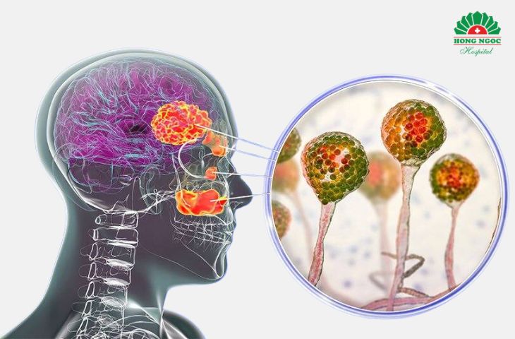 Viêm xoang hàm do nấm là tình trạng tương đối phổ biến