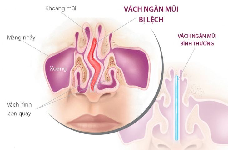 Vách ngăn mũi bị lệch là nguyên nhân dẫn đến viêm xoang trán