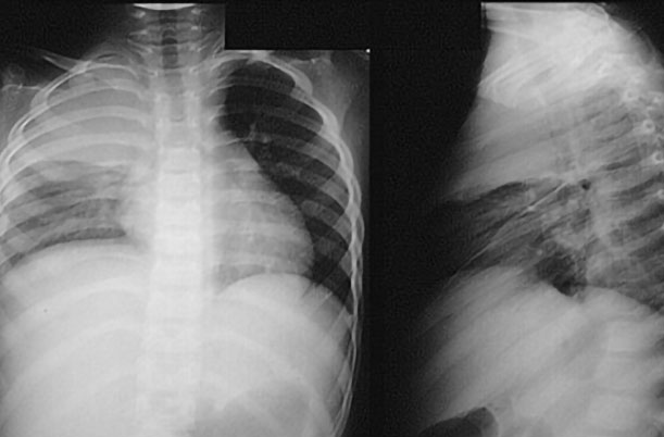 viem-phoi-co-sot-khong-1