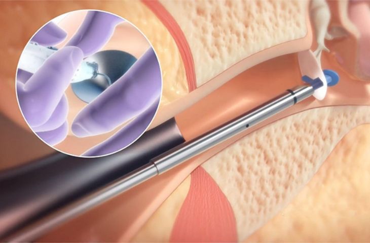 Đặt ống thông khí là một phương pháp điều trị viêm tai giữa ở trẻ em