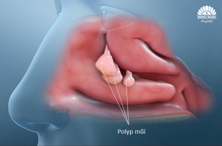 Trường hợp cần mổ nội soi polyp mũi
