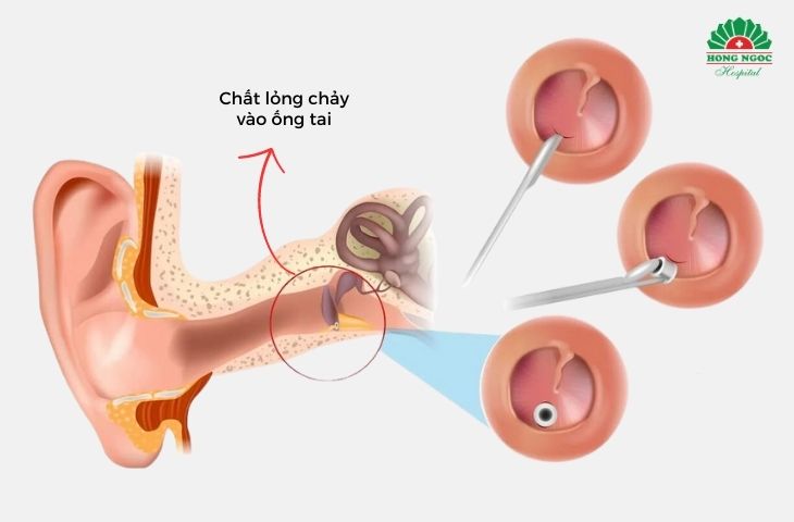 Phẫu thuật tai - Mô phỏng phẫu thuật đặt ống thông khí màng nhĩ