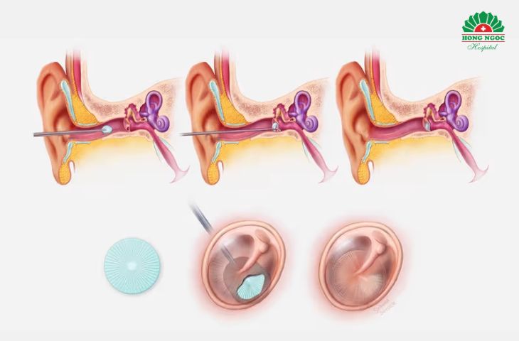 Phẫu thuật tai - Kỹ thuật vá màng nhĩ