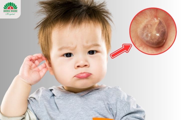 Viêm tai giữa ở trẻ em - Viêm tai giữa ứ dịch