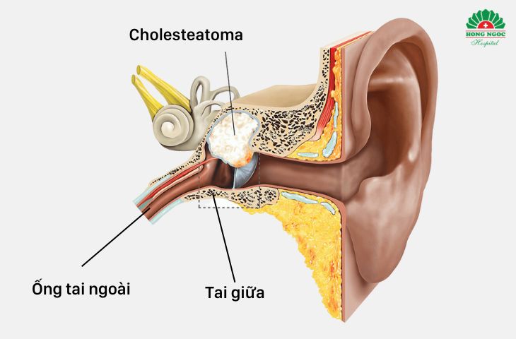 Phẫu thuật chỉnh hình tai giữa được chỉ định với bệnh nhân viêm tai có cholesteatoma