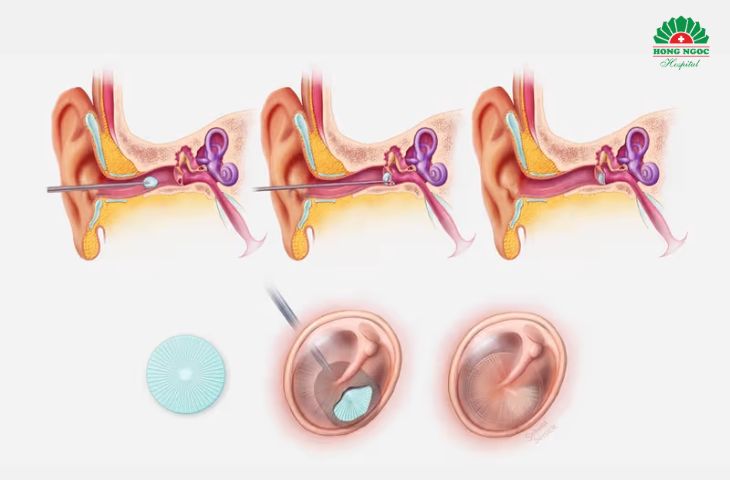 Phẫu thuật chỉnh hình tai giữa giúp tái tạo màng nhĩ
