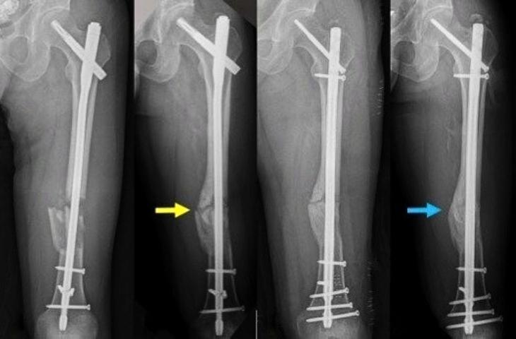 phẫu thuật kết hợp xương sinh học