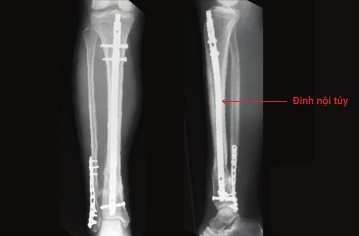 phẫu thuật kết hợp xương sinh học