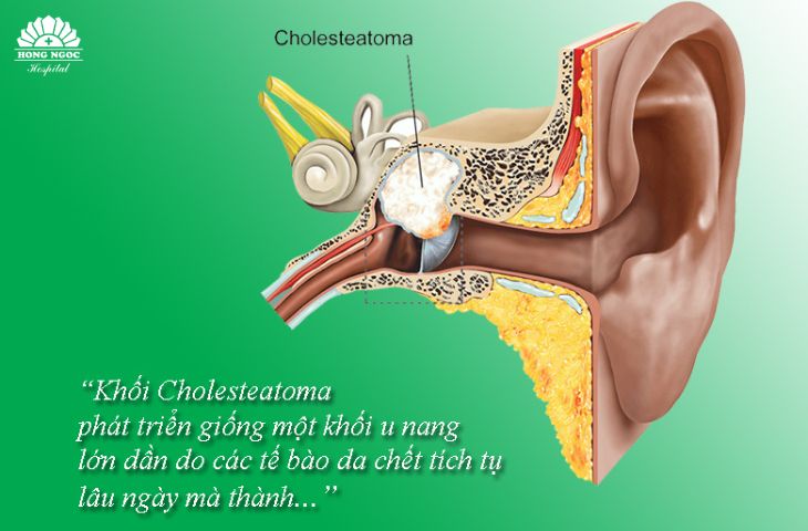 Tìm hiểu về viêm tai cholesteatoma
