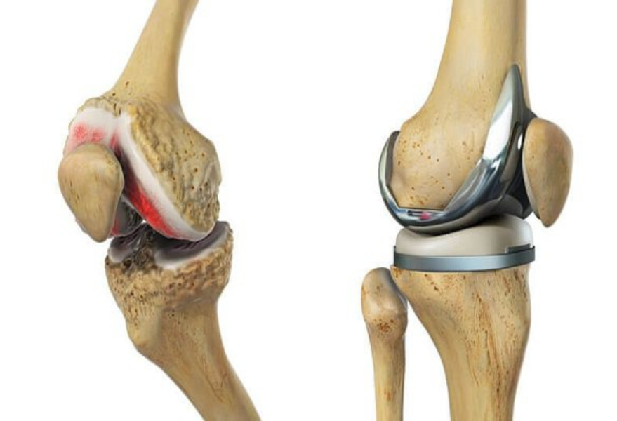 Hình ảnh minh họa thay khớp gối: khớp gối bị thoái hóa nặng và khớp gối nhân tạo sau phẫu thuật thay khớp