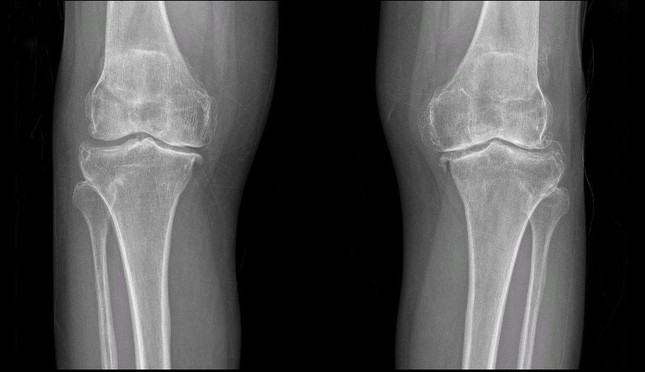 Chụp X-Quang đánh giá tình trạng khớp trước phẫu thuật