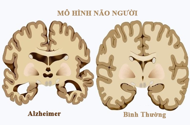 bệnh alzheimer 3